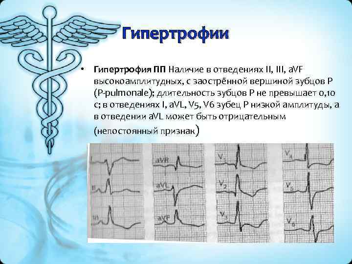 Гипертрофии • Гипертрофия ПП Наличие в отведениях II, III, а. VF высокоамплитудных, с заострённой