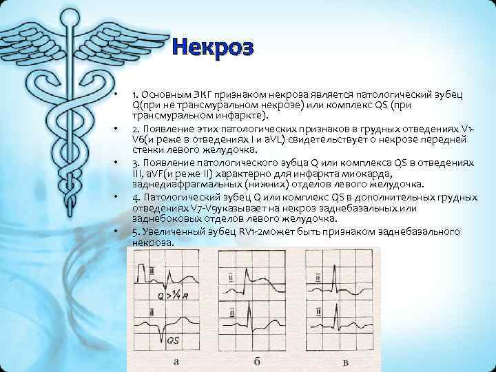 Некроз • • • 1. Основным ЭКГ признаком некроза является патологический зубец Q(при не