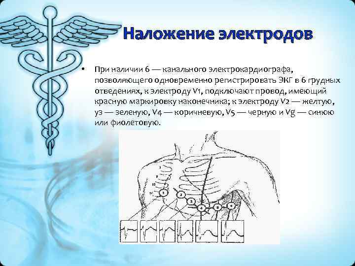 Наложение электродов • При наличии 6 — канального электрокардиографа, позволяющего одновременно регистрировать ЭКГ в