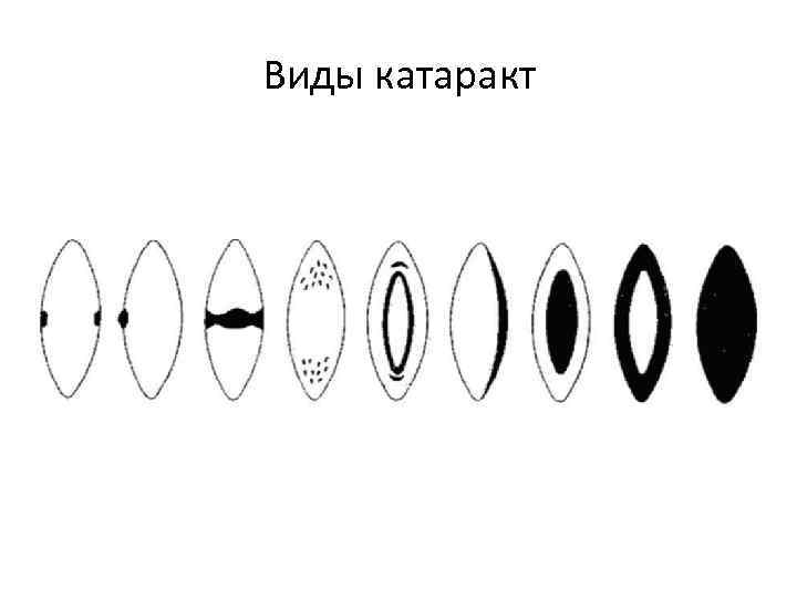 Виды катаракт 