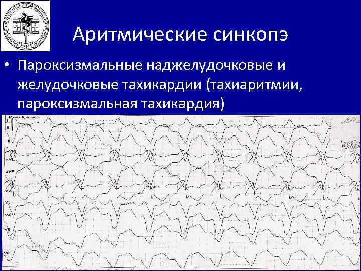 Пароксизмальная тахиаритмия