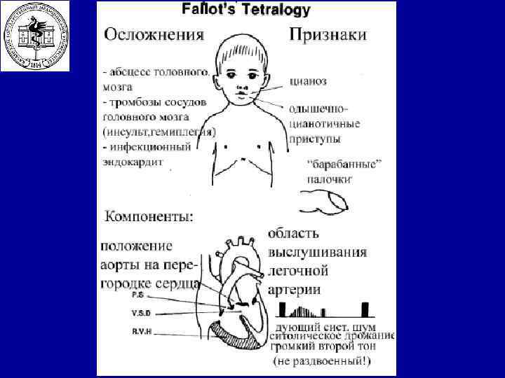 Тетрада фалло у детей