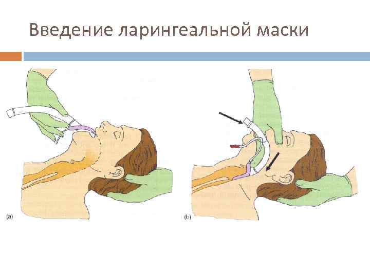 Введение ларингеальной маски 