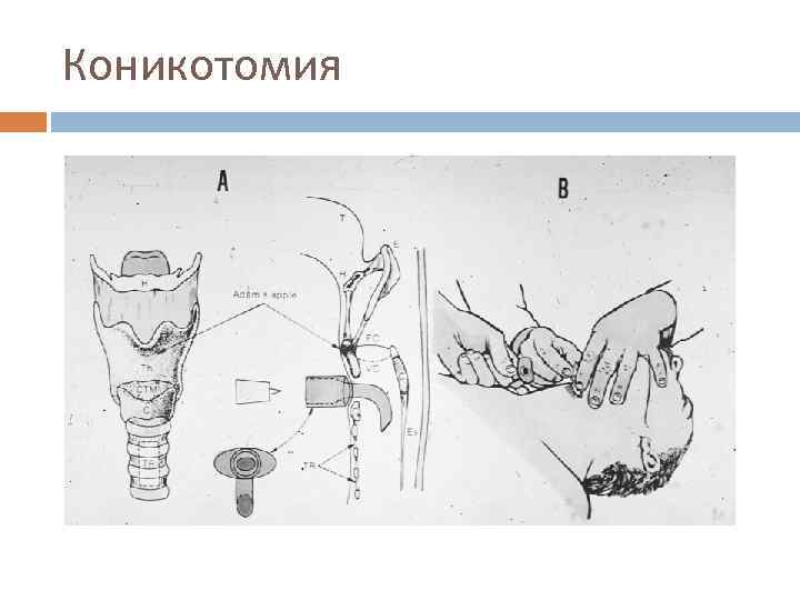 Коникотомия 