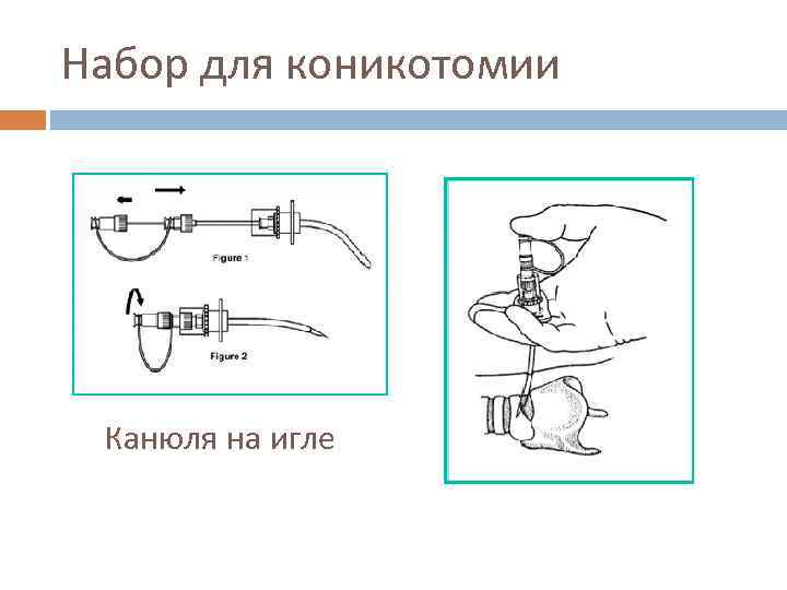 Набор для коникотомии Канюля на игле 