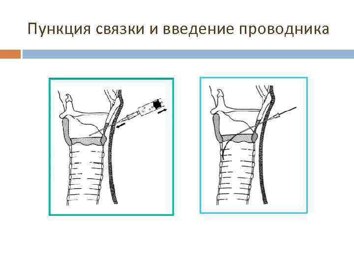 Пункция связки и введение проводника 