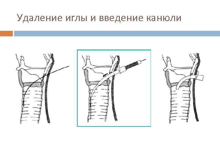 Удаление иглы и введение канюли 