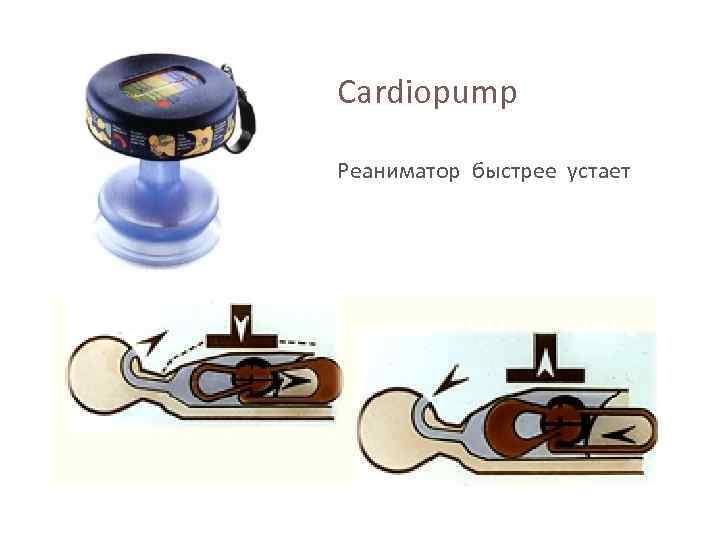 Cardiopump Реаниматор быстрее устает 