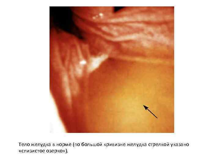 Тело желудка в норме (по большой кривизне желудка стрелкой указано «слизистое озерко» ). 