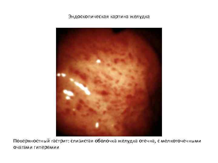 Эндоскопическая картина желудка Поверхностный гастрит: слизистая оболочка желудка отечна, с мелкоточечными очагами гиперемии 