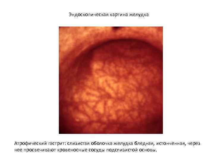 Эндоскопическая картина желудка Атрофический гастрит: слизистая оболочка желудка бледная, истонченная, через нее просвечивают кровеносные