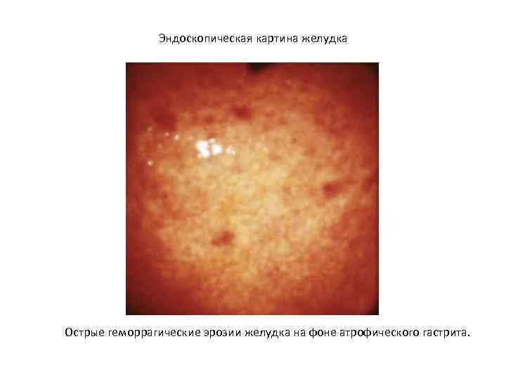 Эндоскопическая картина желудка Острые геморрагические эрозии желудка на фоне атрофического гастрита. 