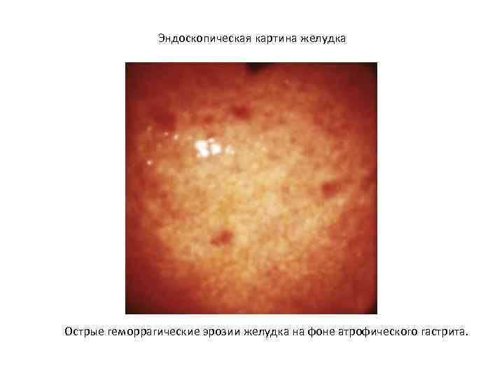 Антральная эритематозная гастропатия на фоне очаговой атрофии слизистой желудка