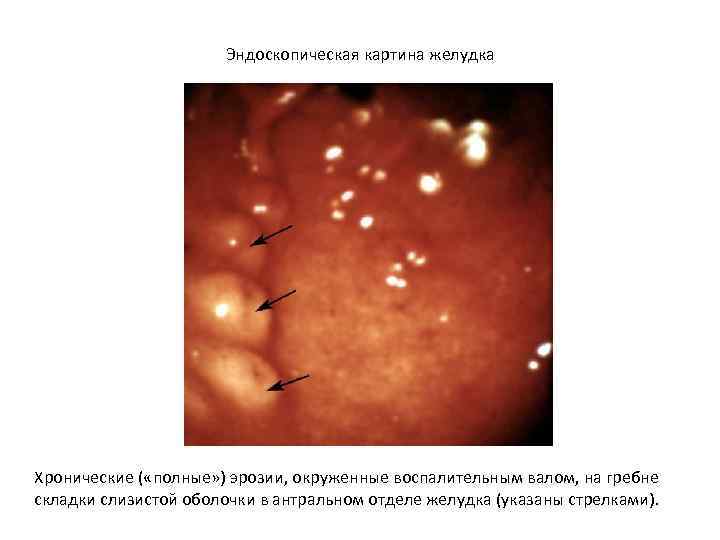 Эндоскопическая картина желудка Хронические ( «полные» ) эрозии, окруженные воспалительным валом, на гребне складки