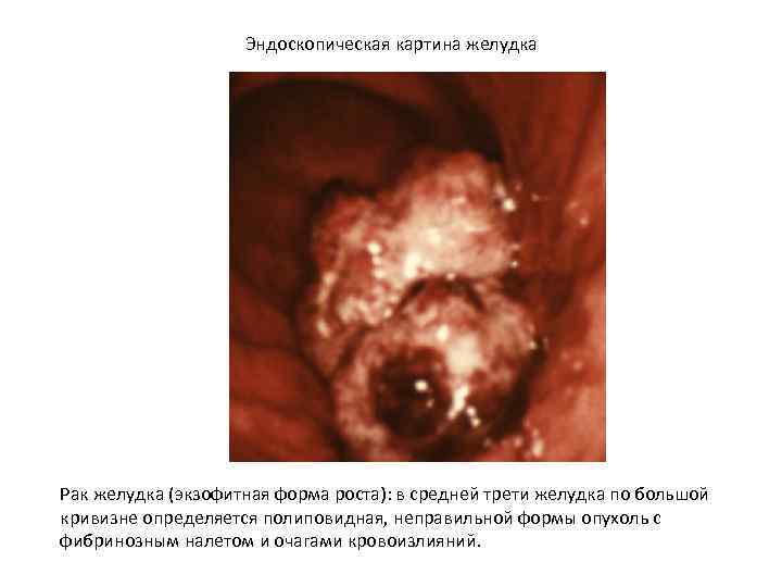 Эндоскопическая картина желудка Рак желудка (экзофитная форма роста): в средней трети желудка по большой
