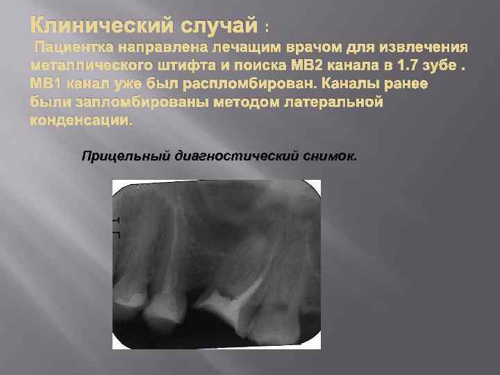 Клинический случай : Пациентка направлена лечащим врачом для извлечения металлического штифта и поиска МВ