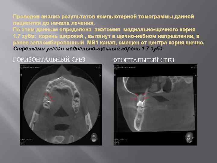 Проведен анализ результатов компьютерной томограммы данной пациентки до начала лечения. По этим данным определена