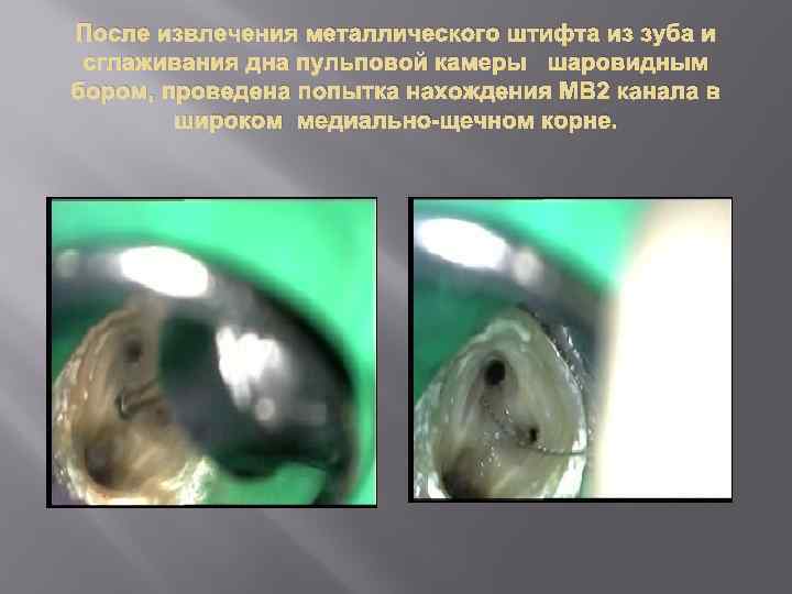 После извлечения металлического штифта из зуба и сглаживания дна пульповой камеры шаровидным бором, проведена