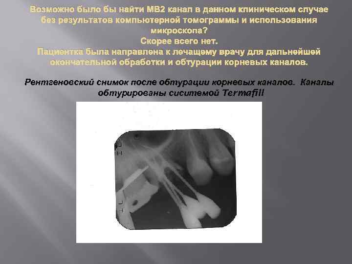 Возможно было бы найти МВ 2 канал в данном клиническом случае без результатов компьютерной