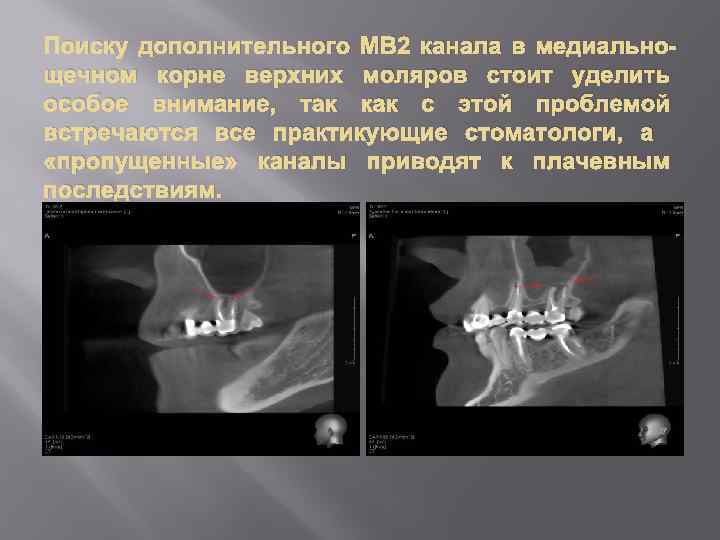 Поиску дополнительного МВ 2 канала в медиальнощечном корне верхних моляров стоит уделить особое внимание,