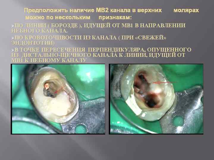 Предположить наличие МВ 2 канала в верхних можно по нескольким признакам: ØПО молярах ЛИНИИ