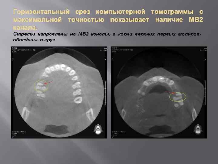 Горизонтальный срез компьютерной томограммы с максимальной точностью показывает наличие МВ 2 канала. Стрелки направлены