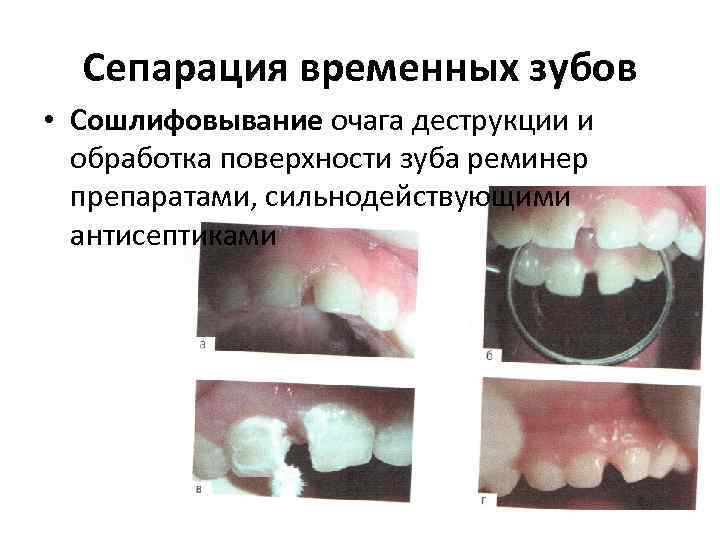 Сепарация временных зубов • Сошлифовывание очага деструкции и обработка поверхности зуба реминер препаратами, сильнодействующими