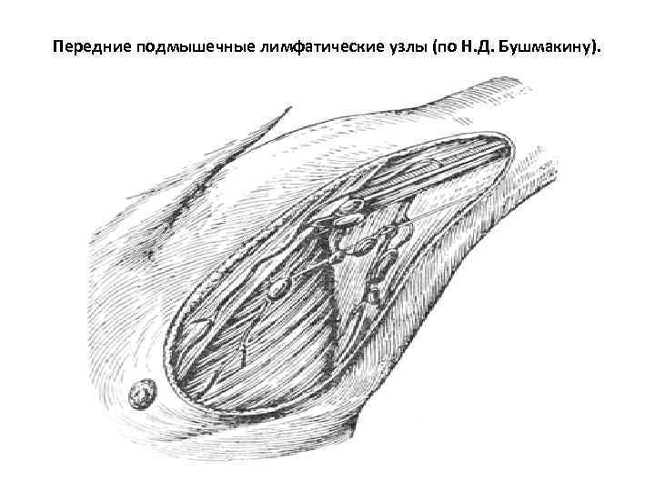 Передние подмышечные лимфатические узлы (по Н. Д. Бушмакину). 