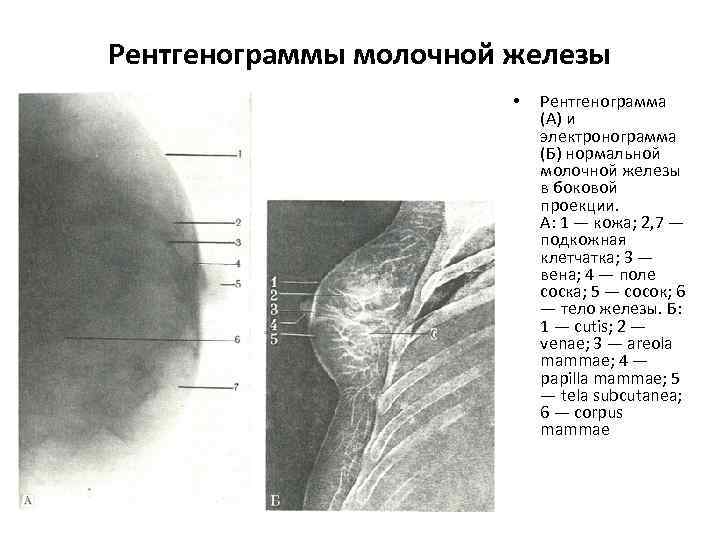 Рентгенограммы молочной железы • Рентгенограмма (А) и электронограмма (Б) нормальной молочной железы в боковой