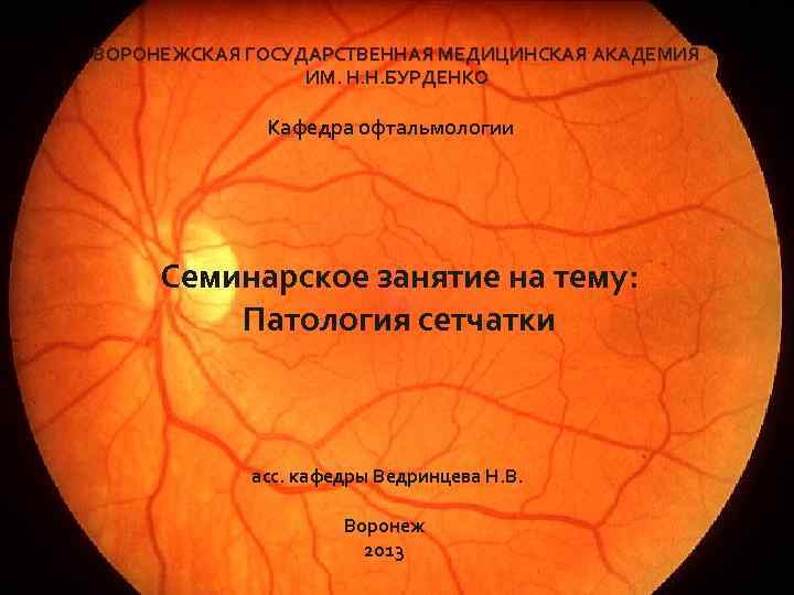 ВОРОНЕЖСКАЯ ГОСУДАРСТВЕННАЯ МЕДИЦИНСКАЯ АКАДЕМИЯ ИМ. Н. Н. БУРДЕНКО Кафедра офтальмологии Патология сетчатки Семинарское занятие