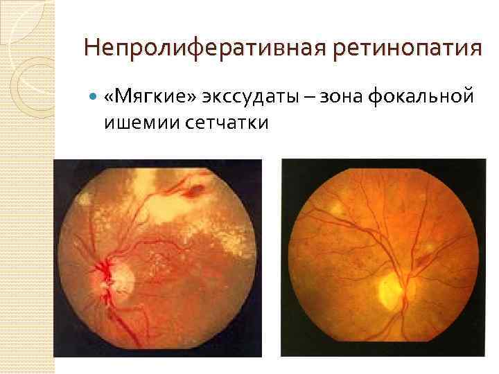 Непролиферативная ретинопатия «Мягкие» экссудаты – зона фокальной ишемии сетчатки 