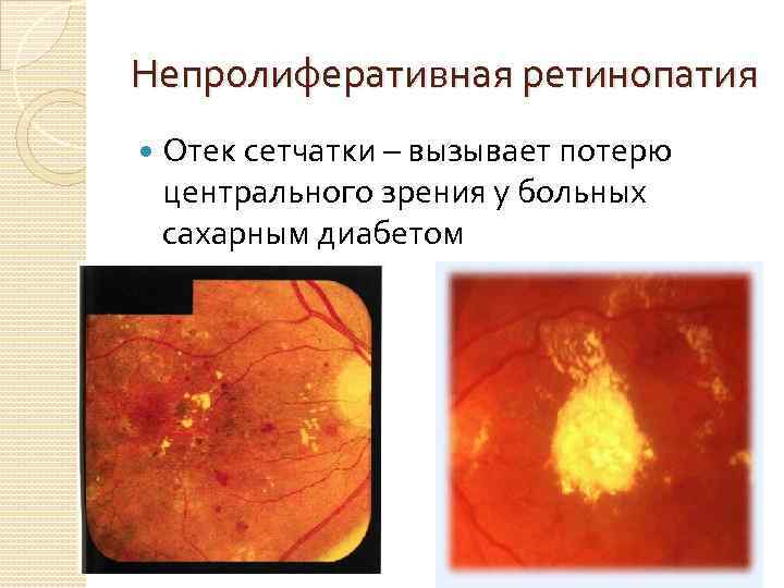 Непролиферативная ретинопатия Отек сетчатки – вызывает потерю центрального зрения у больных сахарным диабетом 