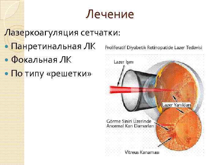 Лазерная Коагуляция Сетчатки Цена К31