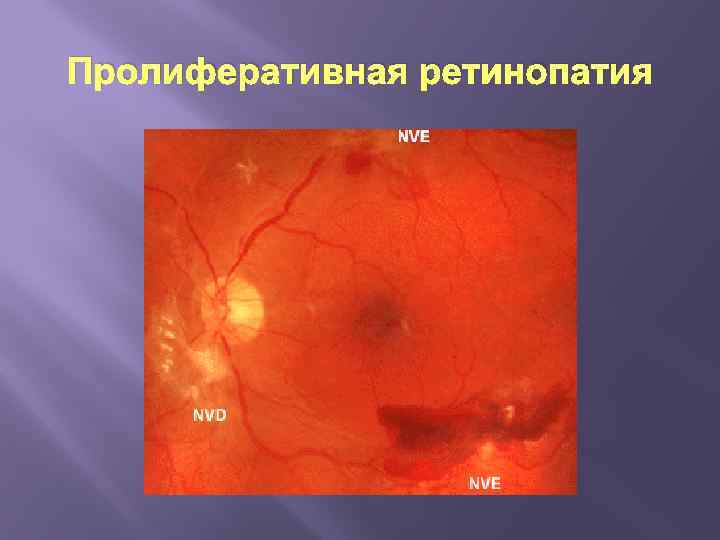 Пролиферативная ретинопатия 