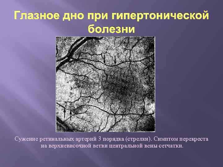 Глазное дно при гипертонической болезни Сужение ретинальных артерий 3 порядка (стрелки). Симптом перекреста на