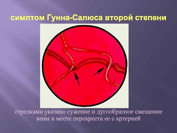 симптом Гунна-Салюса второй степени стрелками указано сужение и дугообразное смещение вены в месте перекреста