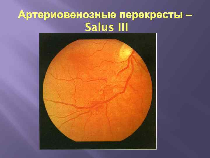 Артериовенозные перекресты – Salus III 