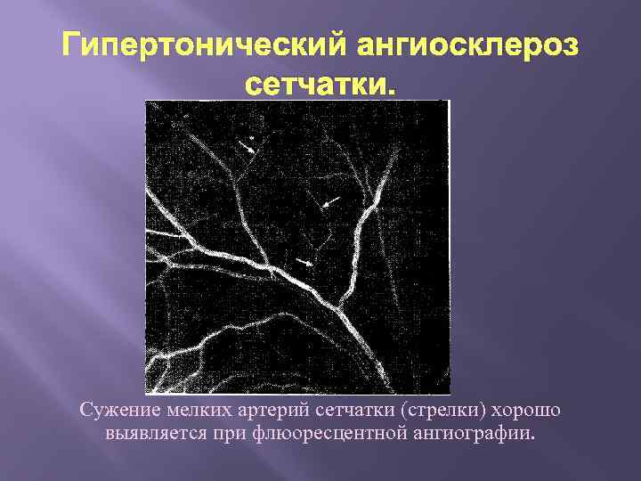 Гипертонический ангиосклероз сетчатки. Сужение мелких артерий сетчатки (стрелки) хорошо выявляется при флюоресцентной ангиографии. 