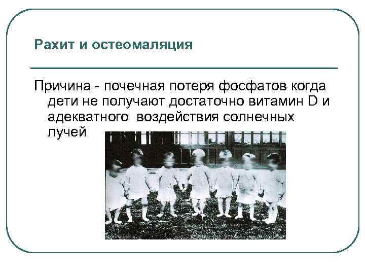 Рахит и остеомаляция Причина - почечная потеря фосфатов когда дети не получают достаточно витамин