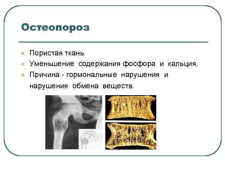 Остеопороз l l l Пористая ткань. Уменьшение содержания фосфора и кальция. Причина - гормональные