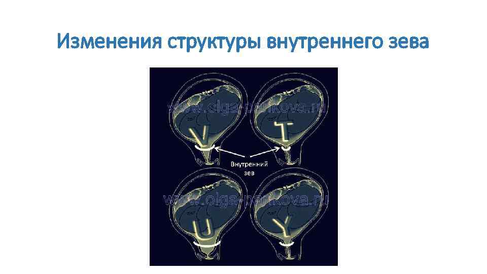 Изменения структуры внутреннего зева 