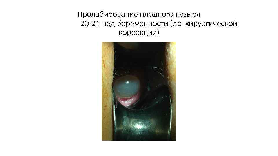 Пролабирование плодного пузыря 20 -21 нед беременности (до хирургической коррекции) 