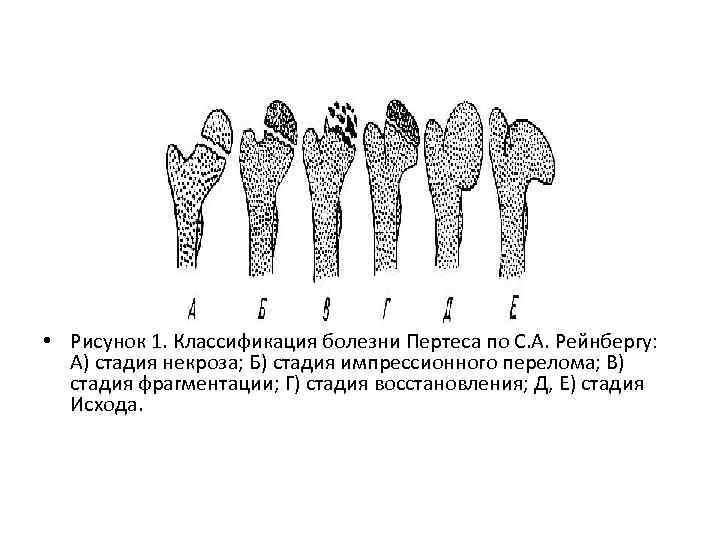 Презентация болезнь пертеса