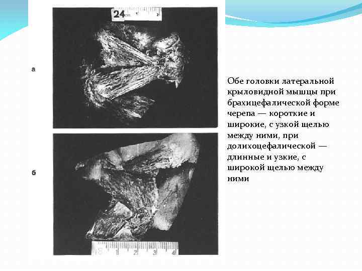 Обе головки латеральной крыловидной мышцы при брахицефалической форме черепа — короткие и широкие, с