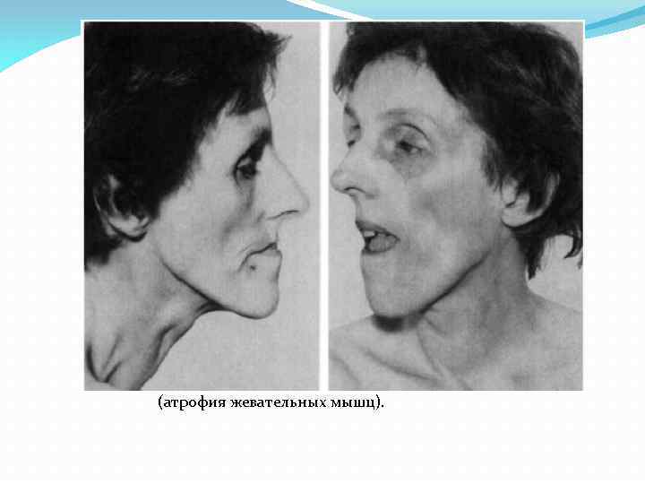 Гипертрофия губ фото