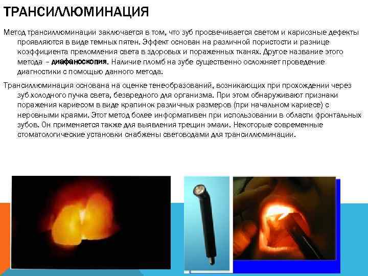 ТРАНСИЛЛЮМИНАЦИЯ Метод трансиллюминации заключается в том, что зуб просвечивается светом и кариозные дефекты проявляются