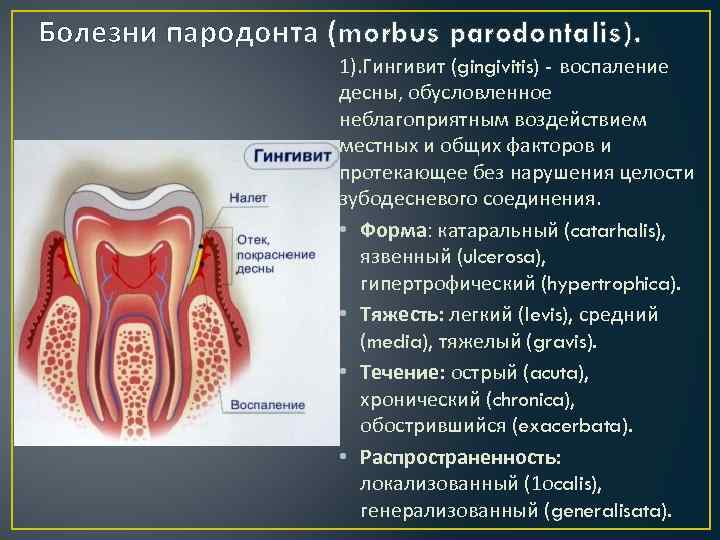 Болезни пародонта (morbus parodontalis). 1). Гингивит (gingivitis) - воспаление десны, обусловленное неблагоприятным воздействием местных