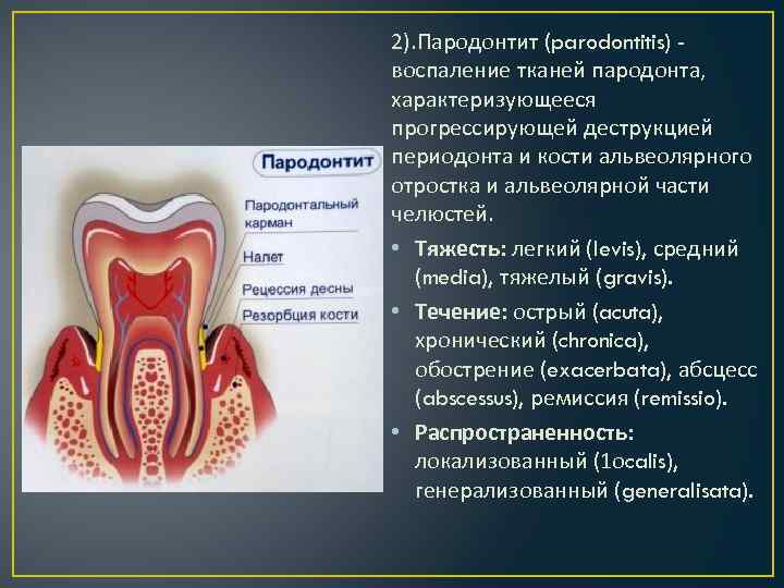 2). Пародонтит (parodontitis) воспаление тканей пародонта, характеризующееся прогрессирующей деструкцией периодонта и кости альвеолярного отростка