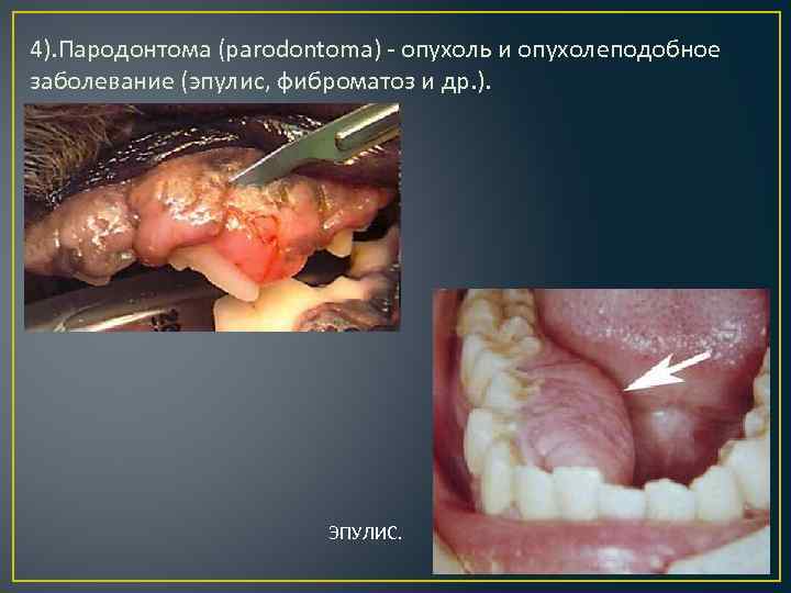 4). Пародонтома (parodontoma) опухоль и опухолеподобное заболевание (эпулис, фиброматоз и др. ). ЭПУЛИС. 