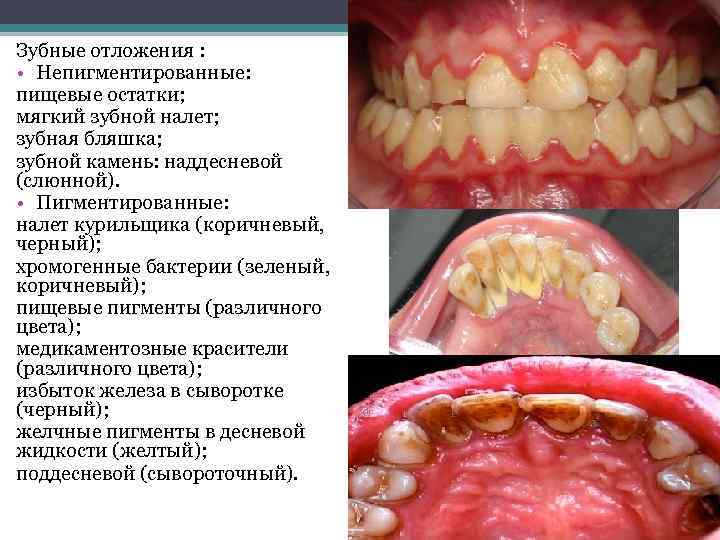 Зубные отложения : • Непигментированные: пищевые остатки; мягкий зубной налет; зубная бляшка; зубной камень: